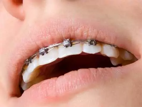 Nowoczesne aparaty ortodontyczne z zamkami samoligaturującymi